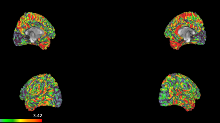 Visualization of cortical thickness of an individual patient with Parkinson’s Disease
