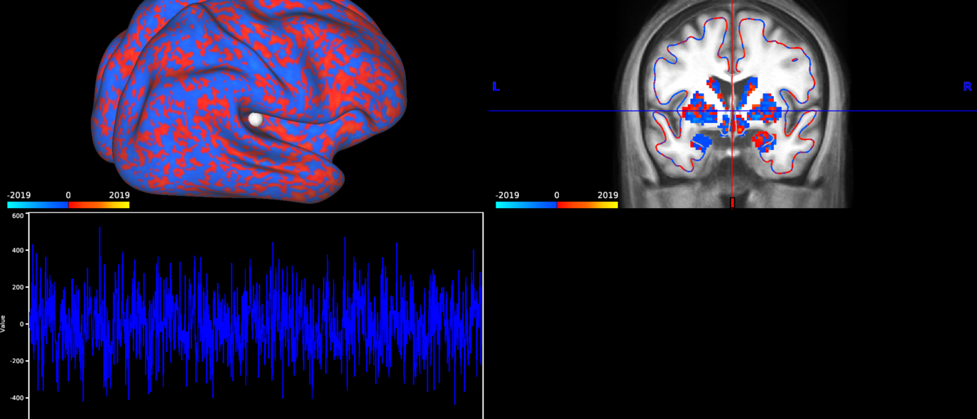 Resting state fRMI image